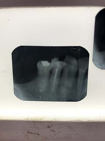 Final de endondocia de el 3.4