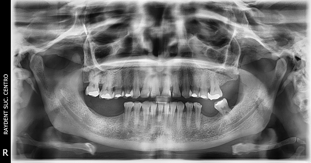 Análisis Radiográfico.