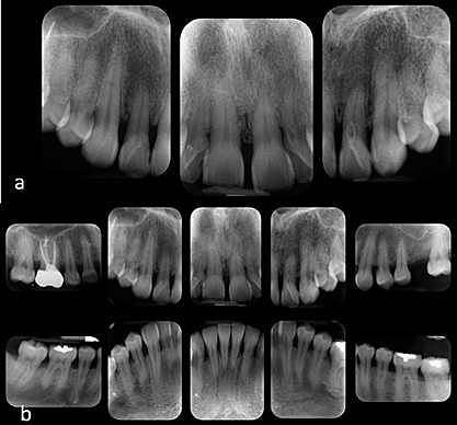 Análisis radiográfico por serie periapical.