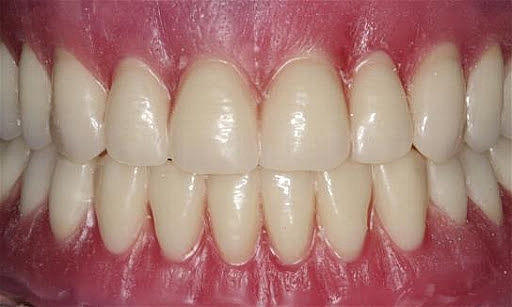 Prueba de dientes en cera.