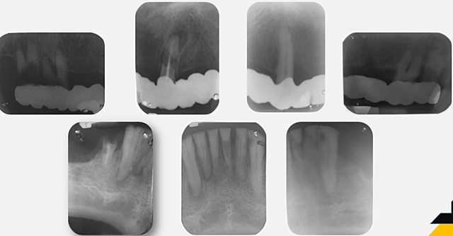 RADIOGRAFÍA PERIAPICAL