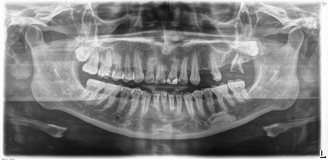 Toma de modelos y radiografía