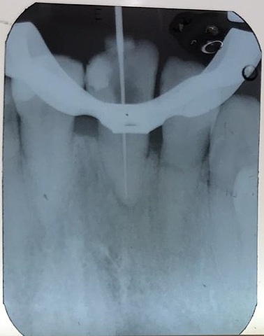 Inicio de endodoncia