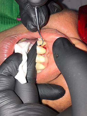 Fase uno periodontal