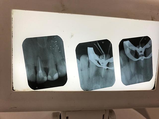 Final de endodóncia