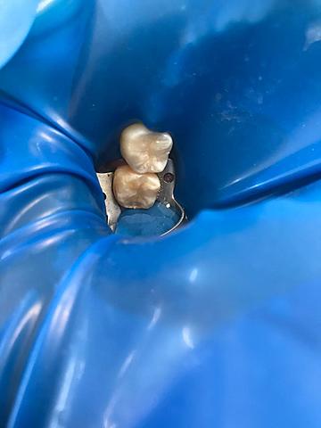 Restauración con resina compuesta