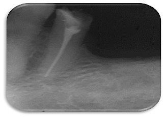 Endodoncia del OD 4.5