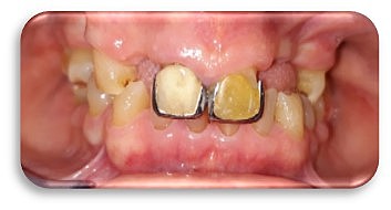 Modelos de estudio y  fotografías intraorales