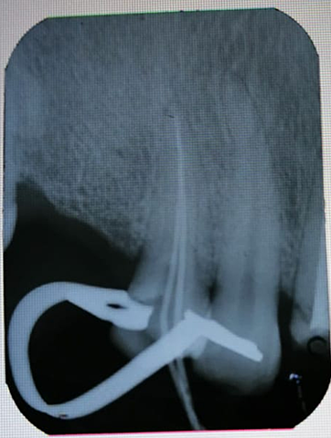 FASE ENDODONTICA