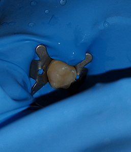 FASE RESTAURADORA (OPERATORIA DENTAL)