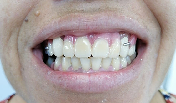 FASE PROTESICA (COLOCACION DE PPR).