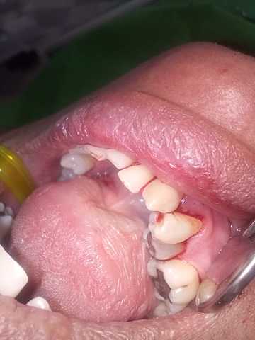 Curetaje cerrado superior