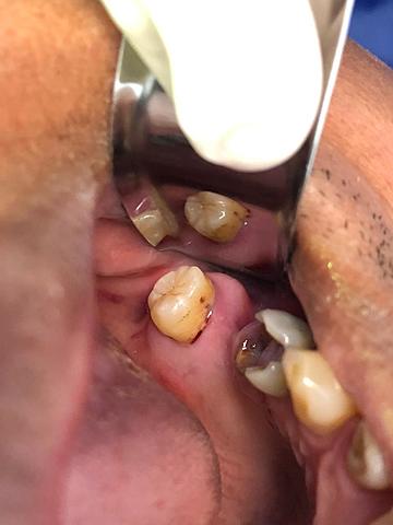 Exodoncia del órgano dentario 1.8