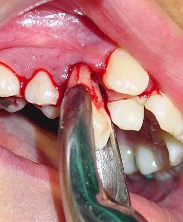 Exodoncia de los órganos dentarios 1.5 y 2.8