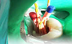 Final del tratamiento endodóntico