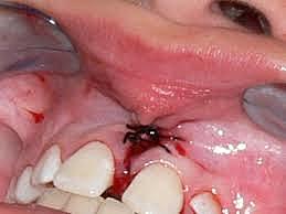 Frenilectomía del frenillo labial superior