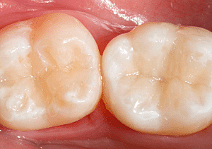 Resinas en los órganos dentarios 3.4, 3.5 y 3.7