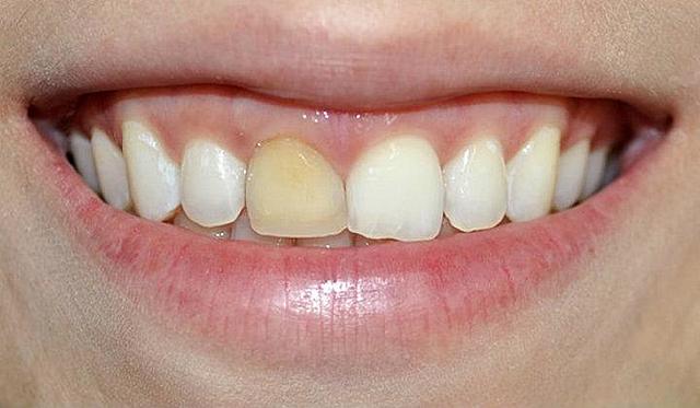 Cambio de restauración filtrada