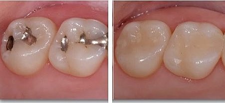 Cambio de restauración filtrada