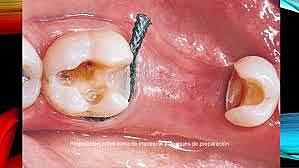 Preparación para incrustación de las piezas 3.6 y 4.7