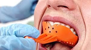 Diseño de prótesis removible