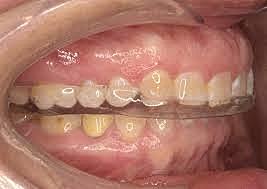 Toma de modelos para guarda oclusal