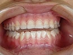 Entrega de guarda oclusal