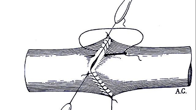 Alexis Carrel y la sutura vascular