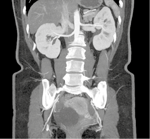 Proyección de intensidad máxima