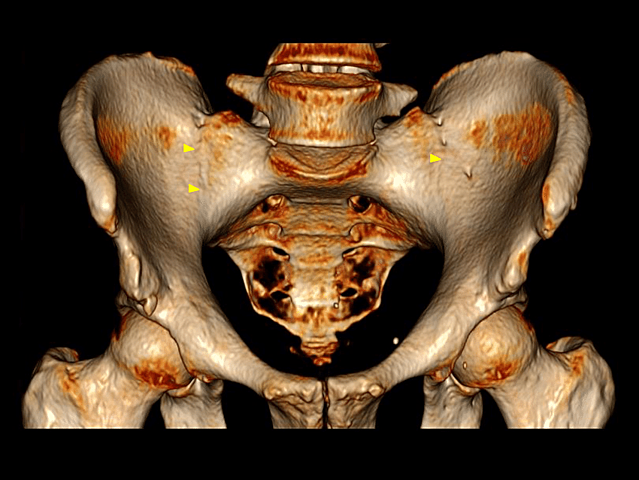 Números obtenidos de la TC.