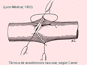 Descubrimiento de la sutura vascular