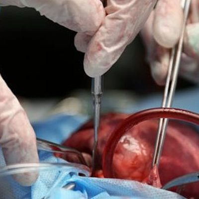 Timeline: LOS TRASPLANTES Y SU HISTORIA