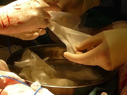 Primer trasplante de piel humana realizado con células del paciente.