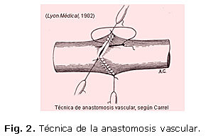 Descubrimiento sutura vascular