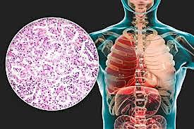 VACUNA CONTRA EL NEUMOCOCO