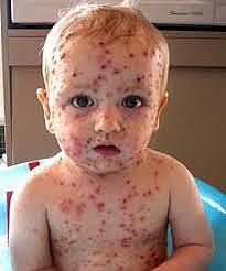 VACUNA CONTRA LA VARICELA