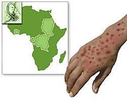 2014  La epidemia de ébola