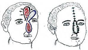 Primera cirugía plástica