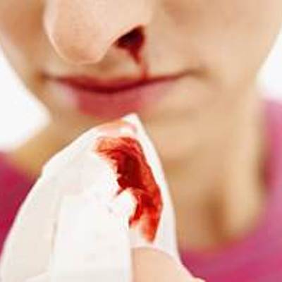 Timeline: Epistaxis