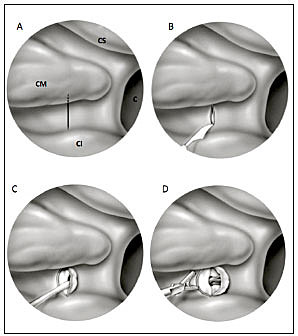 Ligadura arterial