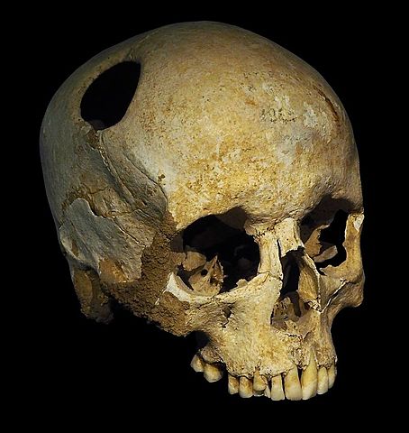 Earliest Evidence of Trepaning