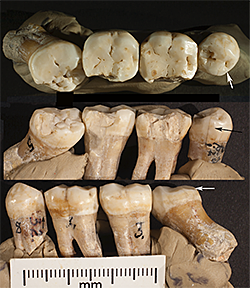 Neanderthal Dentistry