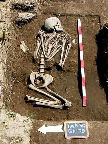 Earliest Surgical Amputations