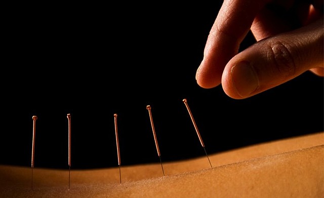 Acupuntura