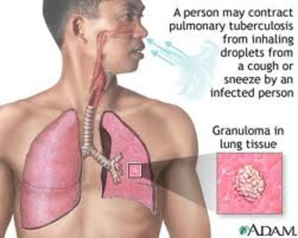 Tuberculosis