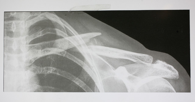 Broke my shoulder.
