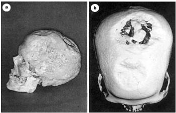 Tratamiento de Enfermedades Mentales