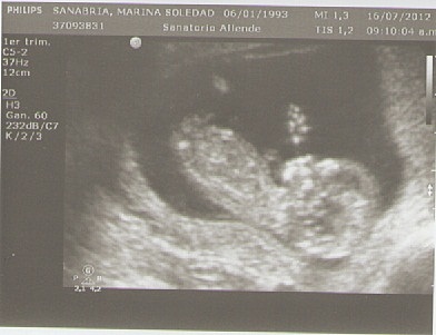 Primer ecografía