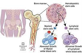 First successful bone marrow transplant from unrelated donor