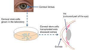 Patients with damaged corneas successfully treated with corneal stem cells